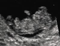 sagital section anencephaly at 10 weeks