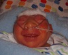 Konnor, baby with anencephaly